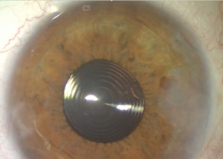 El FacoQuiz de hoy trae un caso aparentemente sencillo pero… La imagen nos muestra un paciente con un implante de un sistema óptico multifocal, ¿pero de qué sistema óptico se trata? La foto está sacada del final del video quirurgico