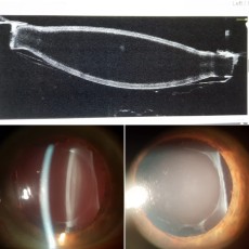 La imagen del FacoArt de esta semana se va a unas muy curiosas de Patricio Navarro y es el de la opacificación de ciertas lentes acrílicas hidrofílicas.  Como podemos ver el cuerpo de la lente permanecía trasparente mientras que es la capa externa de la lente lo que se opacificaba. Pensamos que se debía a que mientras el cuerpo era hidrofílico, a la parte externa se le daba un tratamiento para que se comportara como hidrofóbica. Algo fallaría en ese tratamiento que hizo que se opacificaran muchas de estas lentes. Por cierto que hubo varios fabricantes en Alemania con este sistema al que comparaban con un tomate en cuanto al contenido de una forma y le revestimiento de otra.