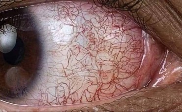 Hoy colgamos una Foto en el FacoArt de la Dra. Filomena Ribeiro en la que nos muestra una conjuntivitis... artística. Algo más que vasos caprichosos.