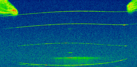 El FacoArt de hoy lo dedicamos a una imagen de un sistema AddOn. Abajo una Tecnis monofocal y encima una Sulcoflex de Rayner. Esta lente se implantó para corregir un defecto refractivo y una disfotopsia negativa de borde. Se consiguieron ambos objetivos al quedar la lente casi pegada al iris/pupila. El reflejo dentro de la Tecnis es un artefacto.