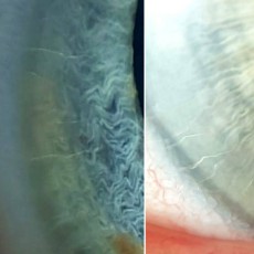 Os vamos a plantear un FacoArt con una duda. Ojo, no es un Quiz. Patricio Navarro ha sacado estas imágenes del limbo corneal de dos pacientes diferentes. Los dos discutimos si son nervios mielinizados corneales o son una variación de las “Pallisades de Vogt”. ¿Qué opináis?