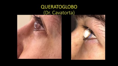 Os compartimos en el FacoArt un espectacular caso de Queratoglobo que nos envía el Dr. Cavatorta de Argentina.