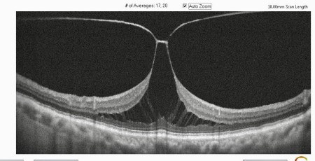 El Dr. Gerardo Valvecchia tenía una ilusión y era ponerle gafas, aéreos, lentes o espejuelos a la retina y no ha parado hasta que lo ha conseguido.
